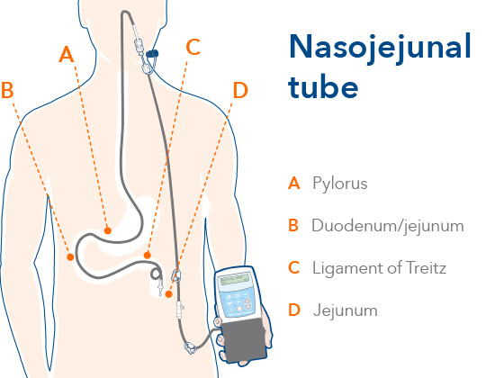 duodopa-en-section4-image8-ALL-DUOD-200035-abbviepro