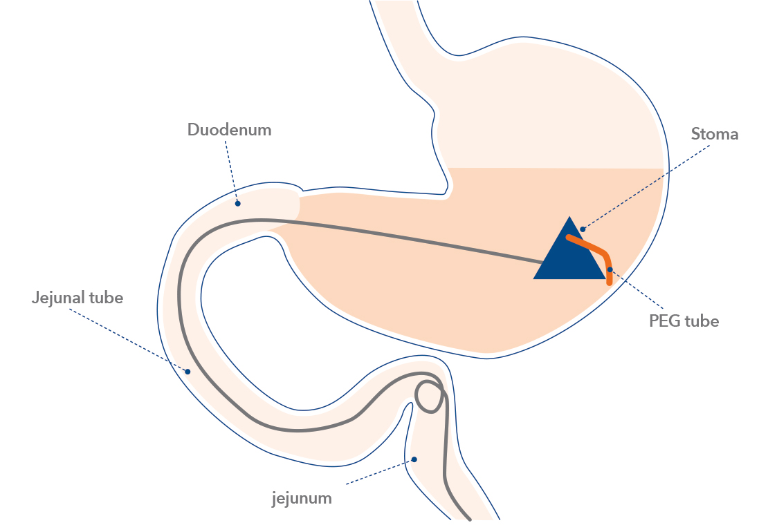 duodopa-en-section4-image9-ALL-DUOD-200035-abbviepro