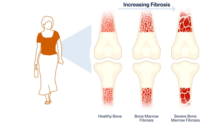 An illustration of 3 bones showing decreasing fibrosis, first with severe bone marrow fibrosis, then bone marrow fibrosis, with healthy bone last